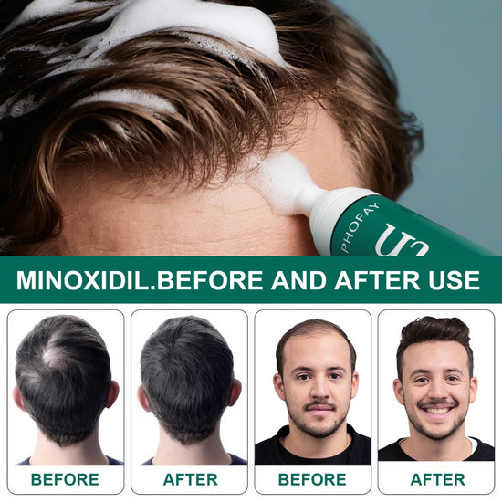 PHOFAY CH004 Minoxidil Anti-Hair Loss Mousse